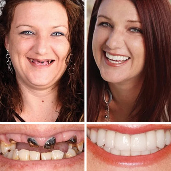 -🌎Ends Today: 70% OFF! ⏰ Medical Full Denture with Strong Suctiond