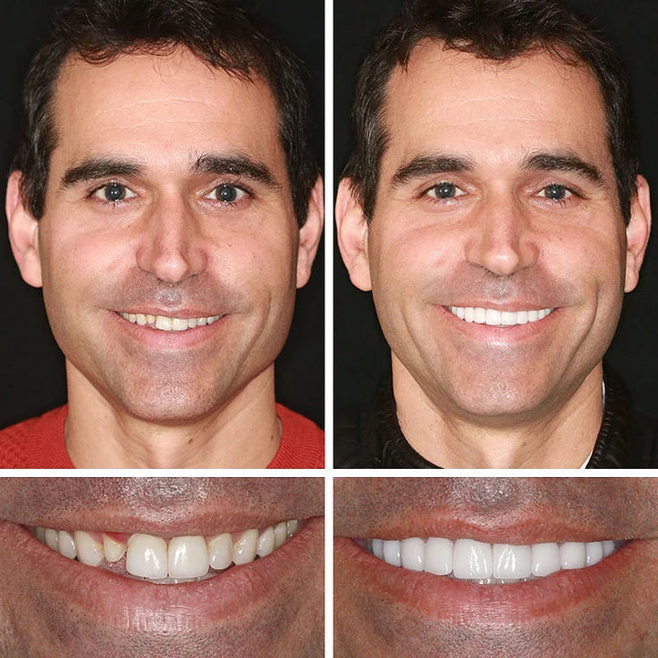 -Ends Today: 70% OFF! ⏰HazyGalaxy™  Medical Full Denture with Strong Suctiond Custom-Fit Full Functional Dentures🦷