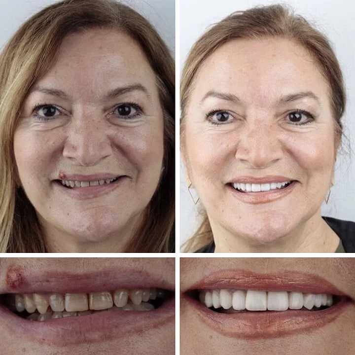 -Ends Today: 75% OFF! ⏰DarkFairy™ Medical Full Denture with Strong Suctiond Custom-Fit Full Functional Dentures🦷