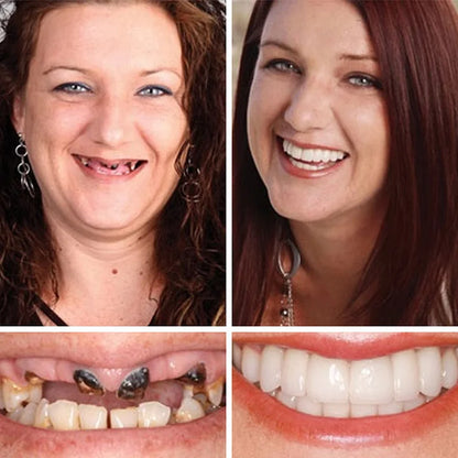 -Ends Today: 75% OFF! ⏰DarkFairy™ Medical Full Denture with Strong Suctiond Custom-Fit Full Functional Dentures🦷