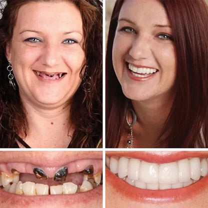 HazyGalaxy™ Soft Silicone Carbon Ceramic Teeth, Strong and White – Natural Look, Comfortable Fit
