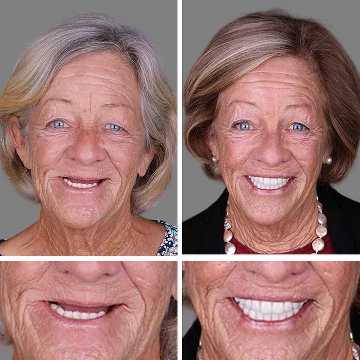 -Ends Today: 70% OFF! ⏰HazyGalaxy™  Medical Full Denture with Strong Suctiond Custom-Fit Full Functional Dentures🦷